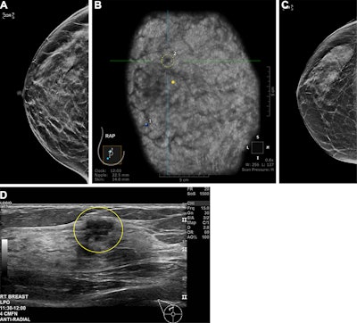 Ultrasound detects more cancers in high-risk women with dense breasts