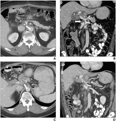 Soft tissue changes on follow-up CT suggest PDAC recurrence postsurgery