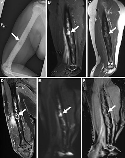 MSKI-RADS effectively classifies MRI findings of extremity infections
