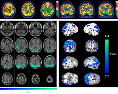 FDG-PET scans can help predict risk of dementia