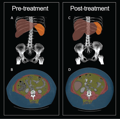 CT shows body composition changes in patients treated with Ozempic
