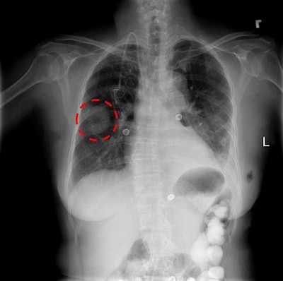 AuntMinnie 2018: NIH releases massive database of chest x-rays