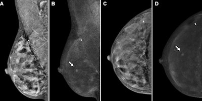 CEM has tradeoffs for imaging extremely dense breasts