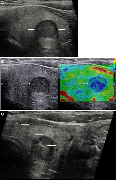 Could elastography replace conventional ultrasound-guided FNAC?