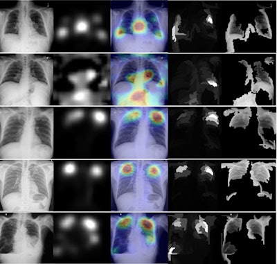 CDC considers chest x-ray AI for TB screening program