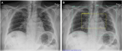 AI lifts nonradiologists’ x-ray interpretation skill levels