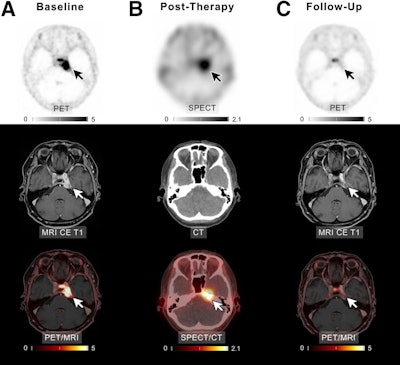 Intraarterial PRRT safe in patients with meningioma