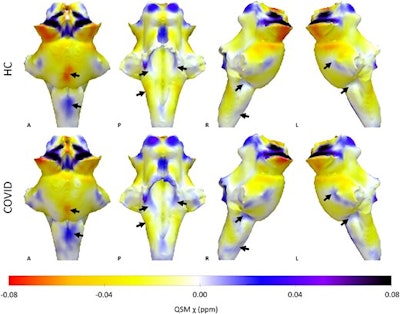 7-tesla MRI uncovers long-term effects of severe COVID-19