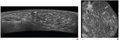 ABUS screening improves breast cancer screening in low-resource areas