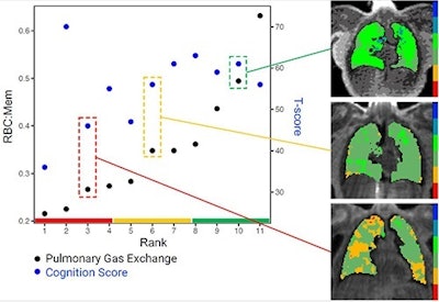 MRI links long-COVID brain fog to lung function