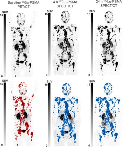 SPECT/CT predicts treatment response in Pluvicto patients