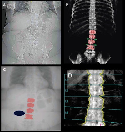 PCCT shows promise for generating opportunistic bone density data