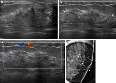 Ultrasound nonmass breast lesion features may signal malignancy