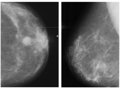 Study shows women will pay for AI breast cancer screening exam