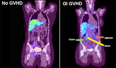 PET visualizes acute graft versus host disease