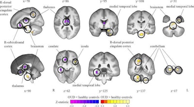 Functional MRI reveals brain changes caused by opioid use