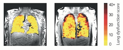 New MRI method shows treatment effects in lung transplant patients