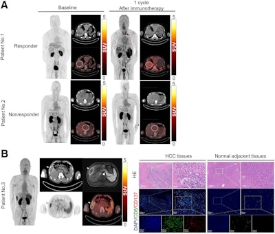 Immuno-PET tracer shows promise in patients with liver cancer