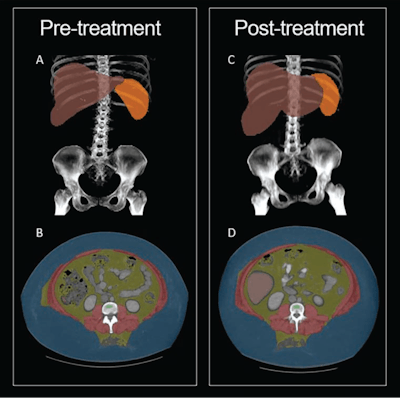 AuntMinnie 2024: CT shows body composition changes in patients treated with Ozempic