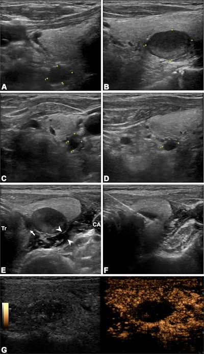 Ultrasound ablation is effective for treating hyperparathyroidism