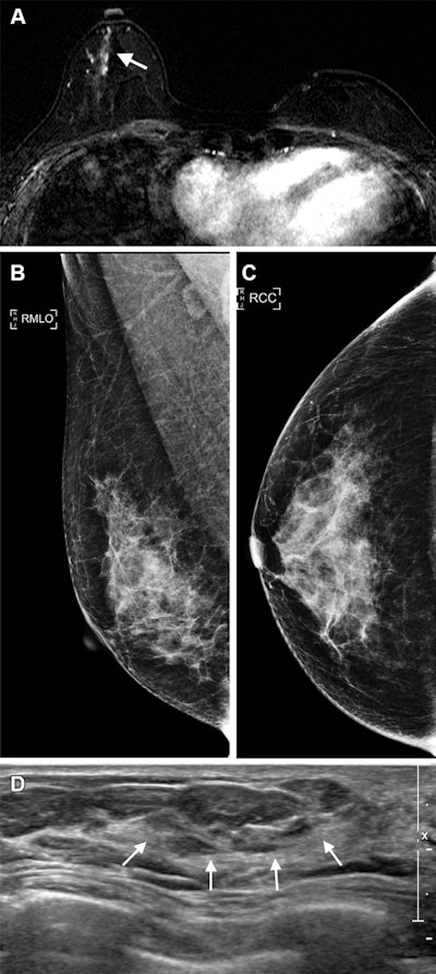 Breast MRI surveillance reduces disease recurrence