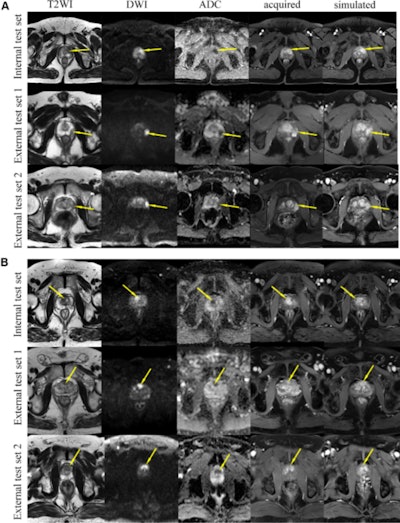 Simulated contrast-enhanced MRI helps assess prostate cancer