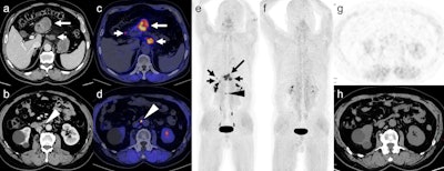 FAPI-PET shows promise for imaging gastric cancers