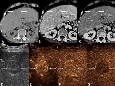 CEUS resolves indeterminate CT, MRI liver observations