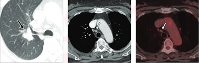 Lung biomarkers inform patient selection for EBUS-TBNA