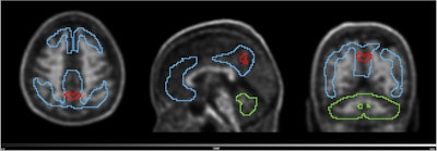 PET scans identify people at early risk for cognitive decline