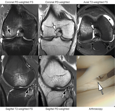 Deep-learning technique boosts diagnostic ability of fast knee MRI