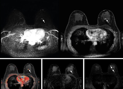 Abbreviated MRI suffices in imaging dense breasts