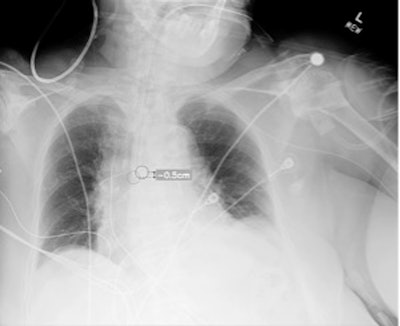 AI helps clinicians identify misplaced endotracheal tubes