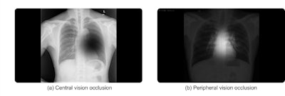 Peripheral vision training improves lesion detection