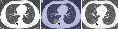 Open-source DL model does well for identifying lung cancer risk