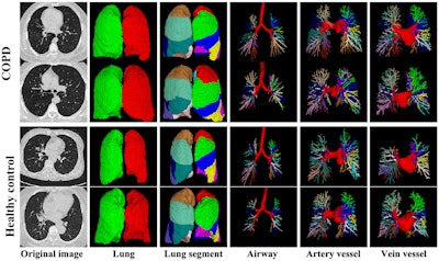 Machine learning plus CT helps assess severity of COPD