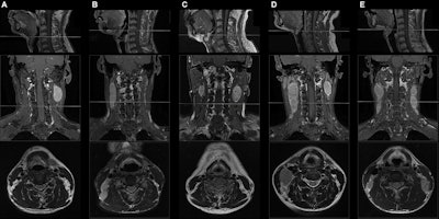 Check for middle neck involvement for nasopharyngeal cancer prognosis