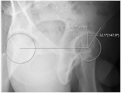Researchers propose new method for measuring hip abnormalities