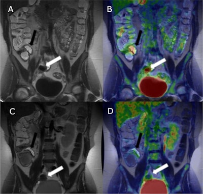 PET/MR enterography shows promise in Crohn’s disease