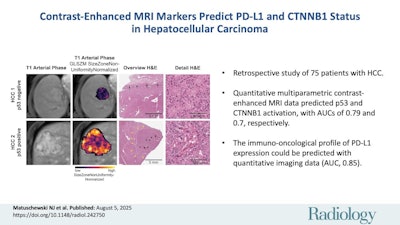 MRI shows promise profiling hepatocellular carcinoma tumors