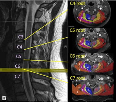 MRI may help guide brachial plexus surgery