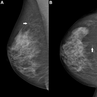 Algorithms from RSNA’s AI mammography challenge perform well