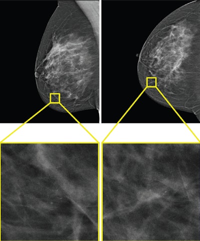 Hybrid AI reading shows success in breast cancer screening