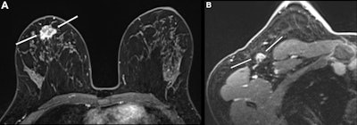 Node-RADS evaluates breast cancers on MRI exams