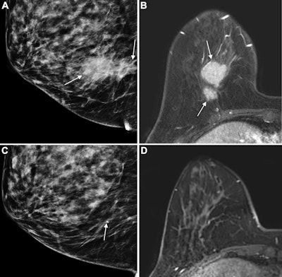 Breast calcifications affect MRI cancer treatment response prediction