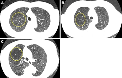 Low-dose CT ties emphysema to mortality in previous smokers