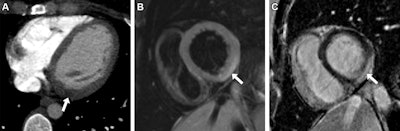 6 key ways to evaluate the heart on chest CT imaging in the ED