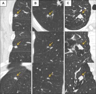 DL algorithm estimates lung nodule cancer risk, reduces false positives