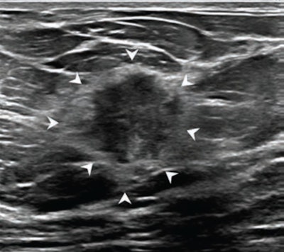 Echogenic rind on breast ultrasound holds diagnostic significance