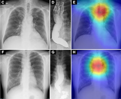 AI model detects achalasia on chest x-rays